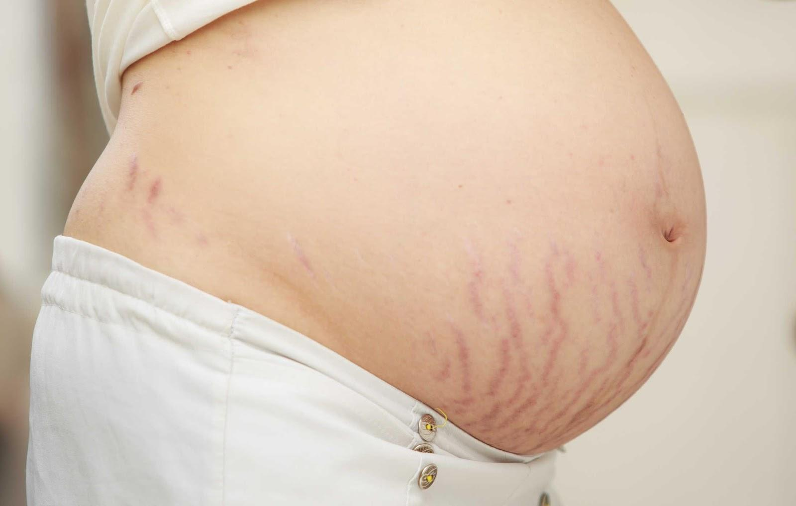 Vết rạn da màu đỏ khi mang thai: Tự khỏi hay phải điều trị?